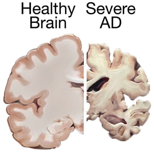 Comparison of a healthy brain and a brain with severe Alzheimer’s Disease. CREDIT: National Institute on Aging, National Institutes of Health.