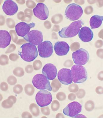 B cell acute lymphoblastic leukemia from a bone marrow aspirate smear. CREDIT:  VashiDonsk at English Wikipedia.