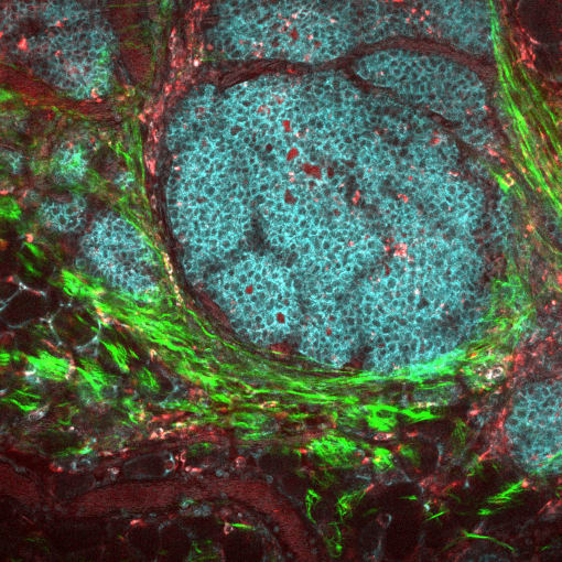 Image of a breast cancer tumor and its microenvironment, obtained from a live mouse model using multiphoton microscopy and endogenous fluorescence. CREDIT: Joseph Szulczewski, David Inman, Kevin Eliceiri, and Patricia Keely, Carbone Cancer Center at the Univ. of Wisconsin, National Cancer Institute, National Institutes of Health.