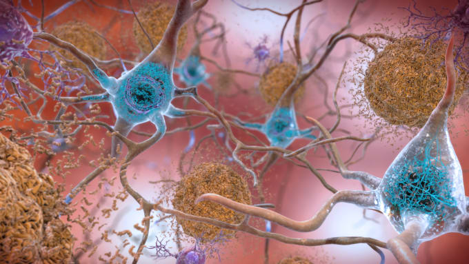 Beta-Amyloid Plaques and Tau tangles in the Brain. In the Alzheimer’s affected brain, abnormal levels of the beta-amyloid protein clump together to form plaques (seen in brown) that collect between neurons and disrupt cell function. Abnormal collections of the tau protein accumulate and form tangles (seen in blue) within neurons, harming synaptic communication between nerve cells. CREDIT: National Institute on Aging, NIH.