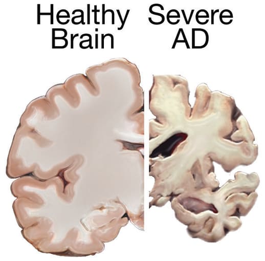 Comparison of a healthy brain and a brain with severe Alzheimer’s Disease. CREDIT: National Institute on Aging, National Institutes of Health.