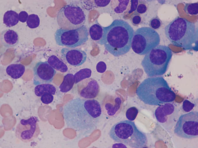 Microscopic images captured from bone marrow aspirate slides of patients diagnosed with multiple myeloma. CREDIT: Gupta, R., & Gupta, A. (2019). MiMM_SBILab Dataset: Microscopic Images of Multiple Myeloma [Data set]. The Cancer Imaging Archive. (CC BY 3.0)
