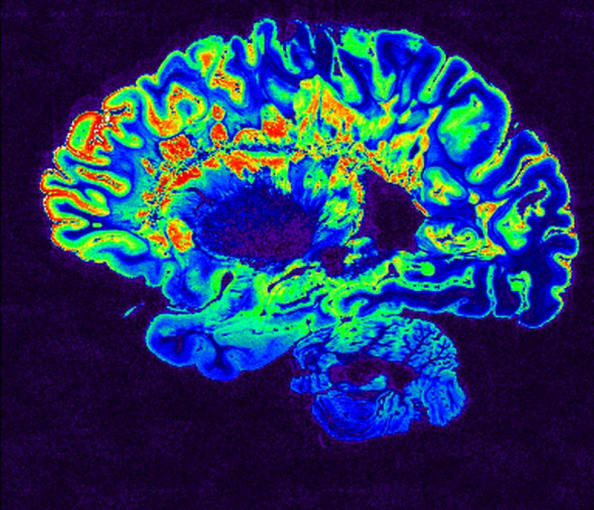 Figure 1. MRI scan of a fixed cerebral hemisphere from a person with multiple sclerosis. Image Credit: Govind Bhagavatheeshwaran, Daniel Reich, National Institute of Neurological Disorders and Stroke, National Institutes of Health