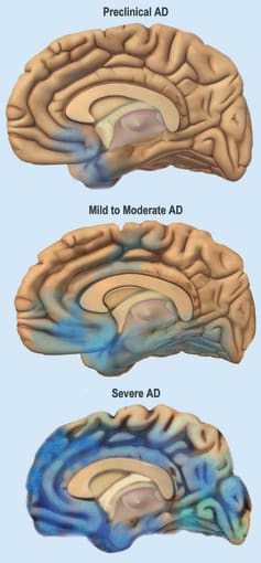 Illustration of how Alzheimer’s disease spreads through the brain. CREDIT: National Institute on Aging, National Institutes of Health.