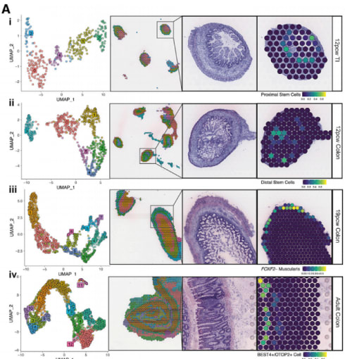 Figure 1. Spatiotemporal analysis of intestinal development with spatial transcriptomics and scRNA-seq integration. UMAP plot of Visium spot transcriptome clusters from each slide shown on left; clusters are visualized on tissue-covered slide areas (left center). Integration with scRNA-seq cell type annotations is shown on the right, with tissue morphology of the region shown right-center for 12 post-conceptual week (PCW) TI (i), 12 PCW colon (ii), 19 PCW colon (iii), and adult colon (iv) slides. All H&E images are from selected areas of Visium slides from the following tissue sections: A6 (i), A8 (ii), A4 (iii), and A1 (iv). Image and caption adapted from Figure 2, Panel A of Fawkner-Corbett et al. 2021 (some panels not shown) and used under a Creative Commons Attribution 4.0 International License (CC BY 4.0).