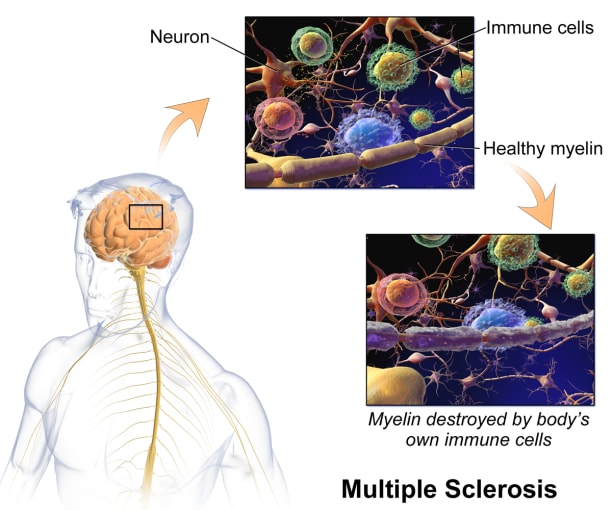 Visualization of immune cells attacking myelin in multiple sclerosis. CREDIT: BruceBlaus (CC BY-SA 4.0).