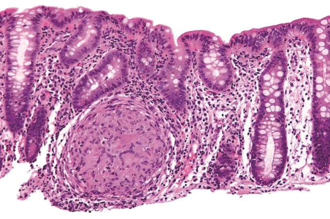 Microscopic image of inflammatory bowel disease. CREDIT: Nephron, Wikimedia Commons.