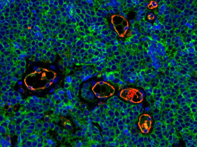 Immunofluorescent staining of Merkel cell carcinoma tumor tissue illustrating expression of CD200 (green) on the surface of tumor cells. CD200 plays a role in immunosuppression. The endothelial marker CD31 (red) highlights blood vessels. Merkel cell carcinoma is a rare and aggressive skin cancer. CREDIT: Isaac Brownell, National Institute of Arthritis and Musculoskeletal and Skin Diseases/NIH