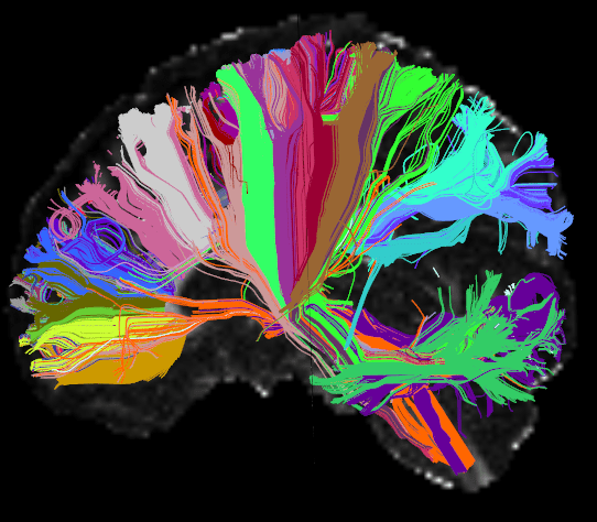 This High Angular Resolution Diffusion Image (HARDI) of the human brain shows long distance connections, or tracts, grouped on the basis of their anatomical neighborhood. Wiring associated with particular brain structures share the same color. CREDIT: Viviana Siless, PhD, Anastasia Yendiki, PhD, MGH/Harvard, Boston Adolescent Neuroimaging of Depression and Anxiety (BANDA)