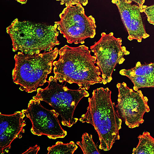 Metastatic melanoma cells. CREDIT: Julio C. Valencia, NCI Center for Cancer Research.