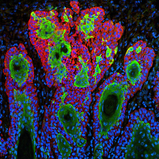 Skin cancer cells—squamous cell carcinoma. This image shows the uncontrolled growth of cells in squamous cell carcinoma, the second most common form of skin cancer. CREDIT: Markus Schober and Elaine Fuchs, The Rockefeller University.