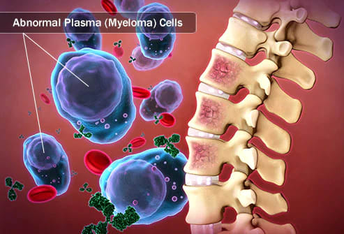 In multiple myeloma, plasma cells in the bone marrow become cancerous by growing out of control and producing abnormal antibodies. Image credit: WebMD.