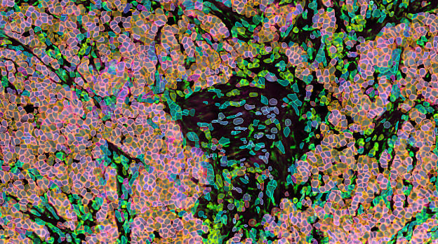 Spatial ligand/receptors biomarkers