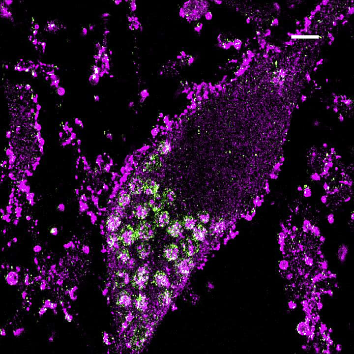 Super-resolution microscopy of a neuron shows the accumulation of lipids within lysosomes that occurs when the gene for prosaposin is suppressed. Credit: UCSF