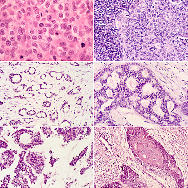 The main histological types of breast cancer. From top left to bottom right: ductal, medullary, tubular, cribriform, mucinous, and (squamous) metaplastic breast cancer. Credit: Atlas of Genetics and Cytogenetics in Oncology and Haematology.