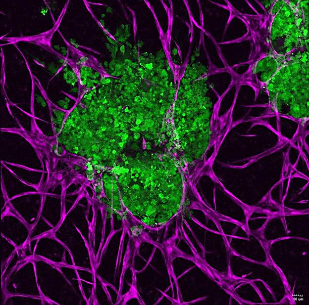 The TME of a 3D-bioprinted breast cancer tumor. Credit: Ozbolat Lab/Penn State.