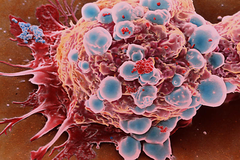 Breast cancer cells leaving the original tumor and spreading to other parts of the body. Credit: Quest/Science Source (via Memorial Sloan Kettering Cancer Center).
