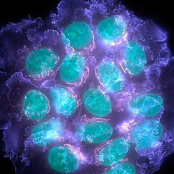 Single breast cancer cells as detected by imaging. Credit: ABC News, Australia.