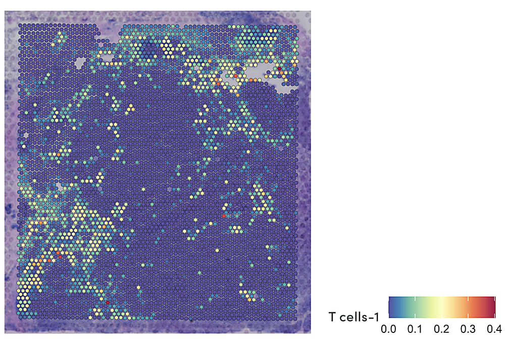 Regions of specific T-cell subtype infiltration, visualized by combining Visium Spatial Gene Expression and single nuclei RNA-seq data. Exhausted T cells can be seen around the tumorigenic region. 