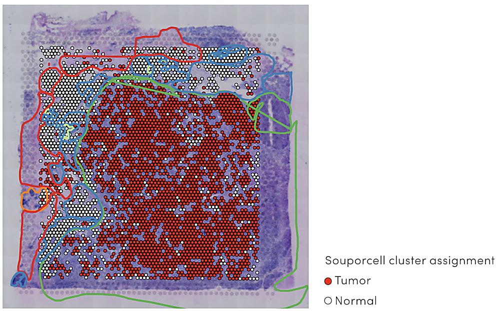 Using gene expression data, the genotype of each Visium spot was inferred as either tumor or normal. Overlaid pathologist annotation is also shown. 