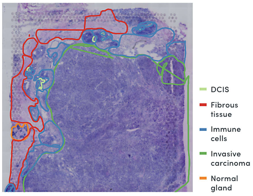 Pathologist annotation of a triple-negative breast cancer sample. 