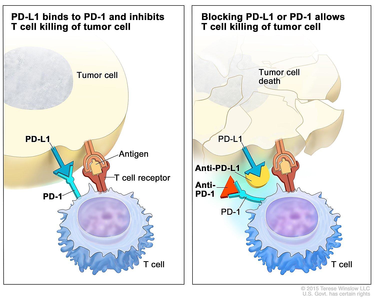 Checkpoint proteins, such as PD-L1 on tumor cells and PD-1 on T cells, help keep immune responses in check. The binding of PD-L1 to PD-1 keeps T cells from killing tumor cells in the body (left panel). Blocking the binding of PD-L1 to PD-1 with an immune checkpoint inhibitor (anti-PD-L1 or anti-PD-1) allows the T cells to kill tumor cells (right panel). Credit: National Cancer Institute.