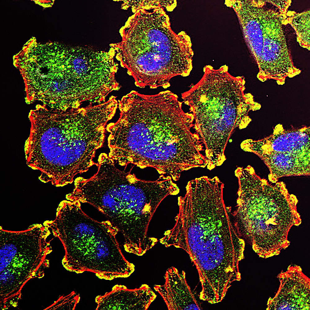 Metastatic melanoma cells. CREDIT: Julio C. Valencia, NCI Center for Cancer Research.