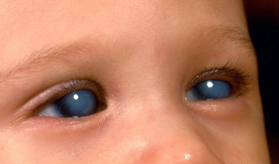 Congenital glaucoma, cloudy corneas. Credit: American Academy of Ophthalmology (http://www.aao.org). 