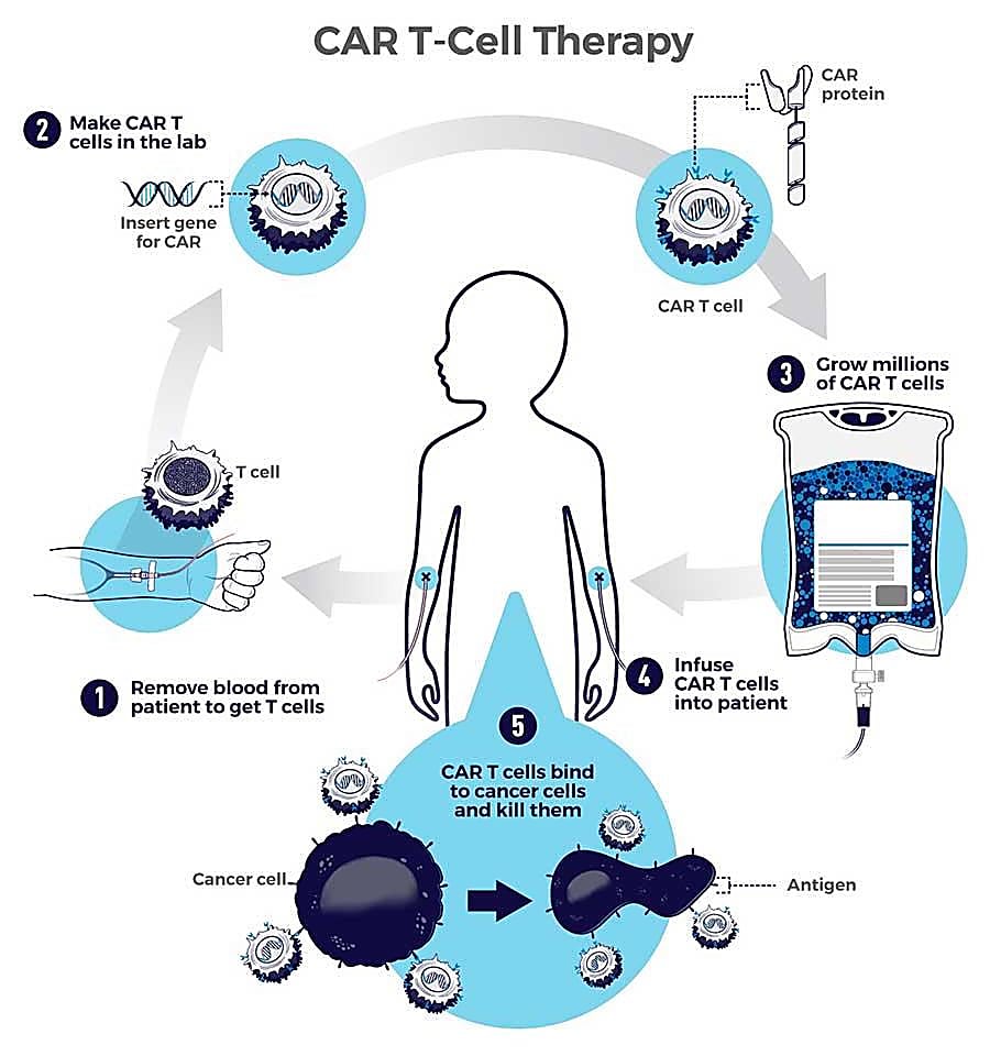 Diagram of CAR T-cell therapy. CREDIT: cancer.gov