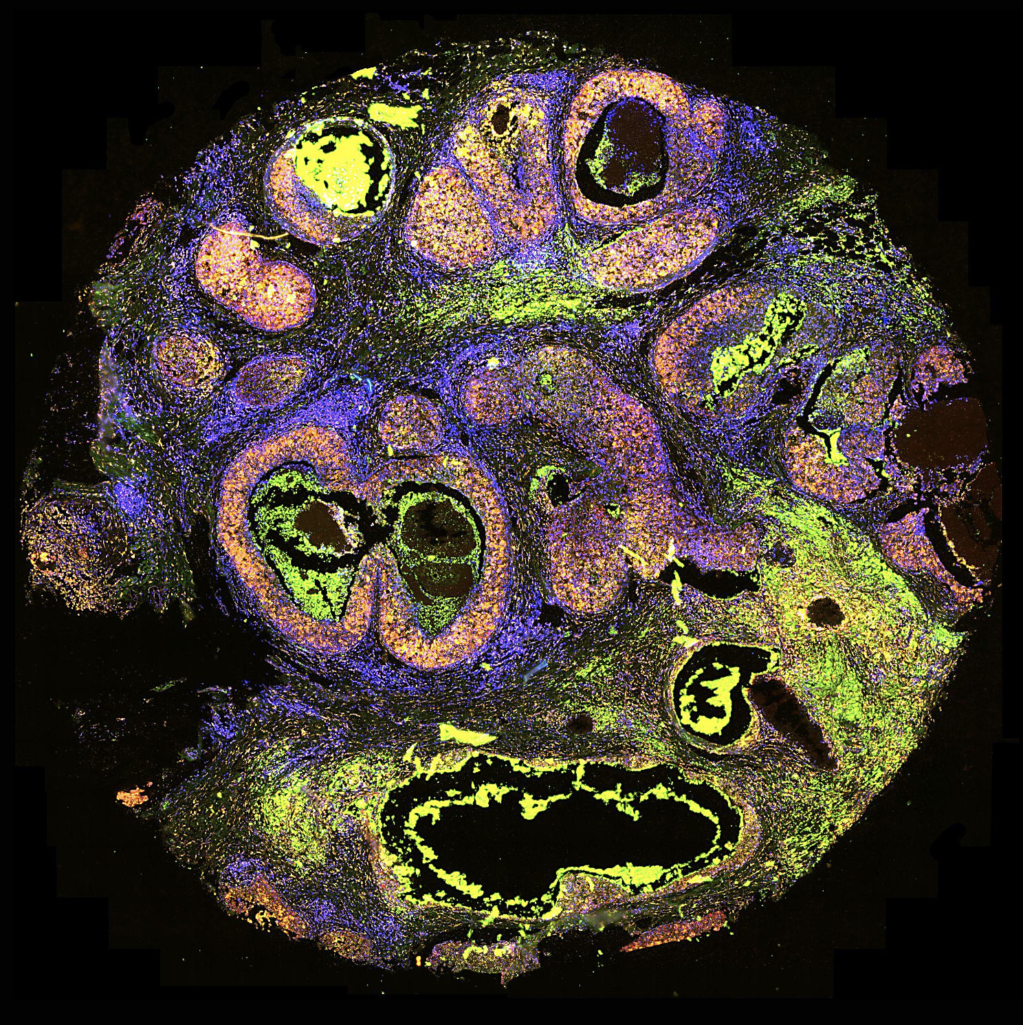 Figure 1. R&D gene expression data from a human breast cancer section using a 200-plex panel on the Xenium In Situ analyzer.