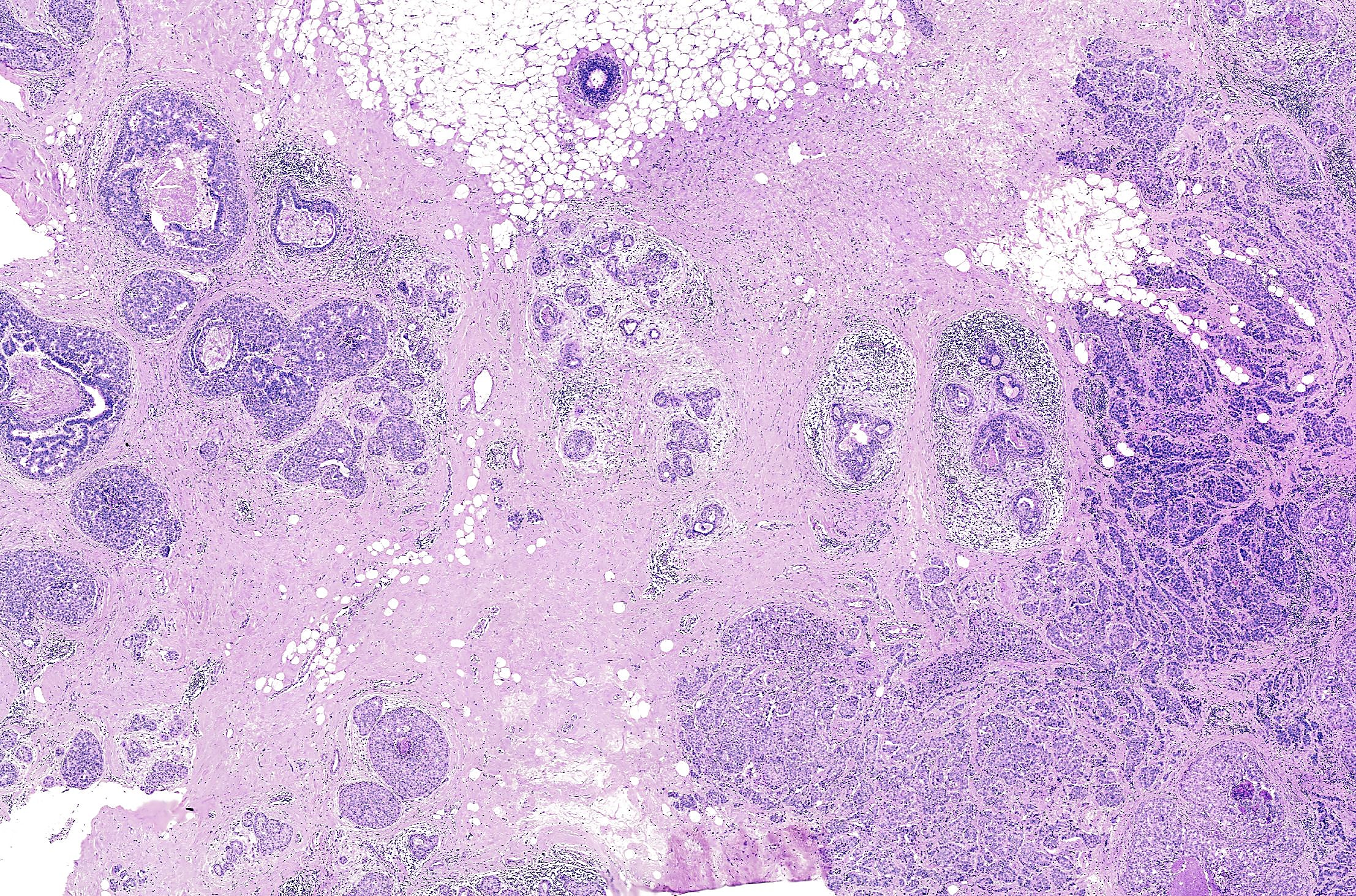 Figure 1. Hematoxylin & Eosin (H&E) image of a formalin-fixed paraffin-embedded (FFPE)-preserved DCIS tissue. Image credit: Janesick A, et al. bioRxiv (2022).