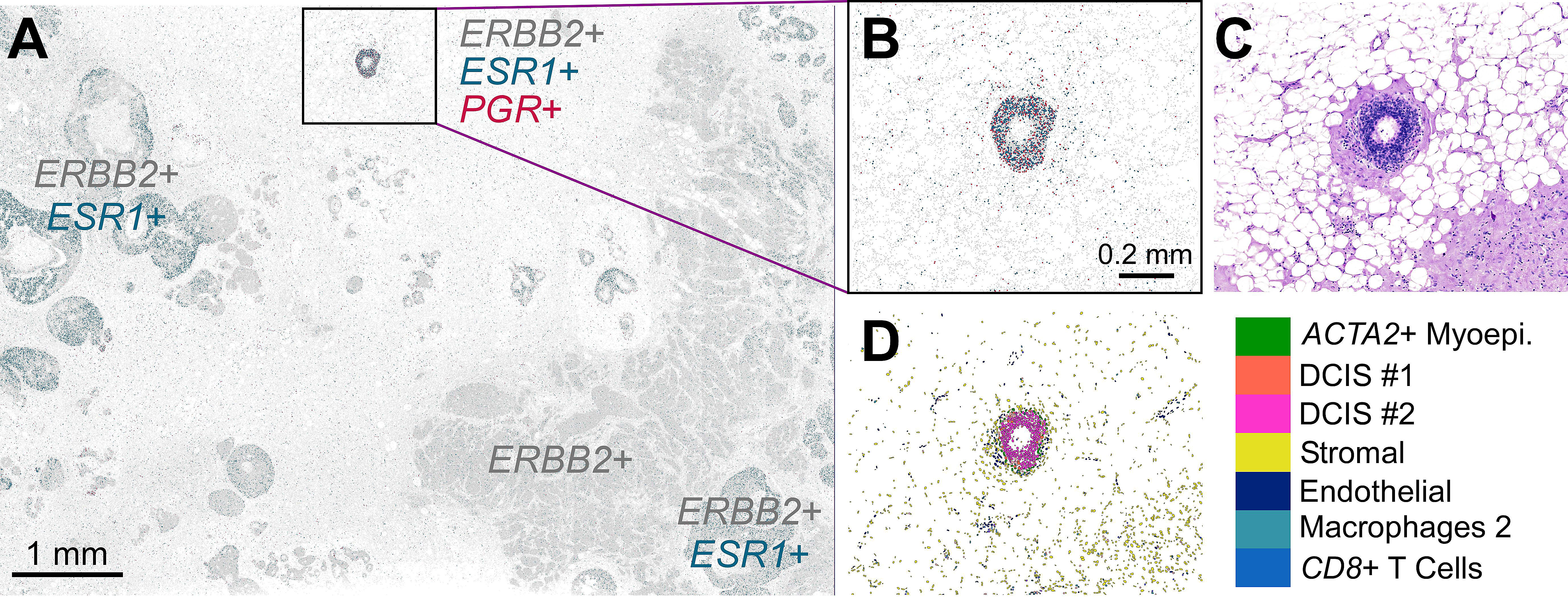 Figure 2. Spatial gene expression profiles of ESR1, ERBB2, and PGR expression (A & B) identifies a small DCIS region that is triple positive for all three receptors. Panel C shows this same region in the H&E image, and Panel D shows the cell-type composition of this region. Image credit: Janesick A, et al. bioRxiv (2022).