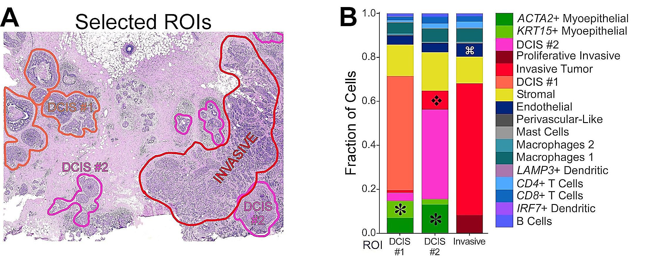 Figure 3. Comprehensive analysis of this biopsy sample, including single cell sequencing of serial sections adjacent to the one analyzed by Xenium, demonstrated a complex tumor landscape with several distinct regions. Panel A shows the location of select regions of interest with the H&E image, and Panel B shows the cellular composition differences between these regions. Image credit: Janesick A, et al. bioRxiv (2022).