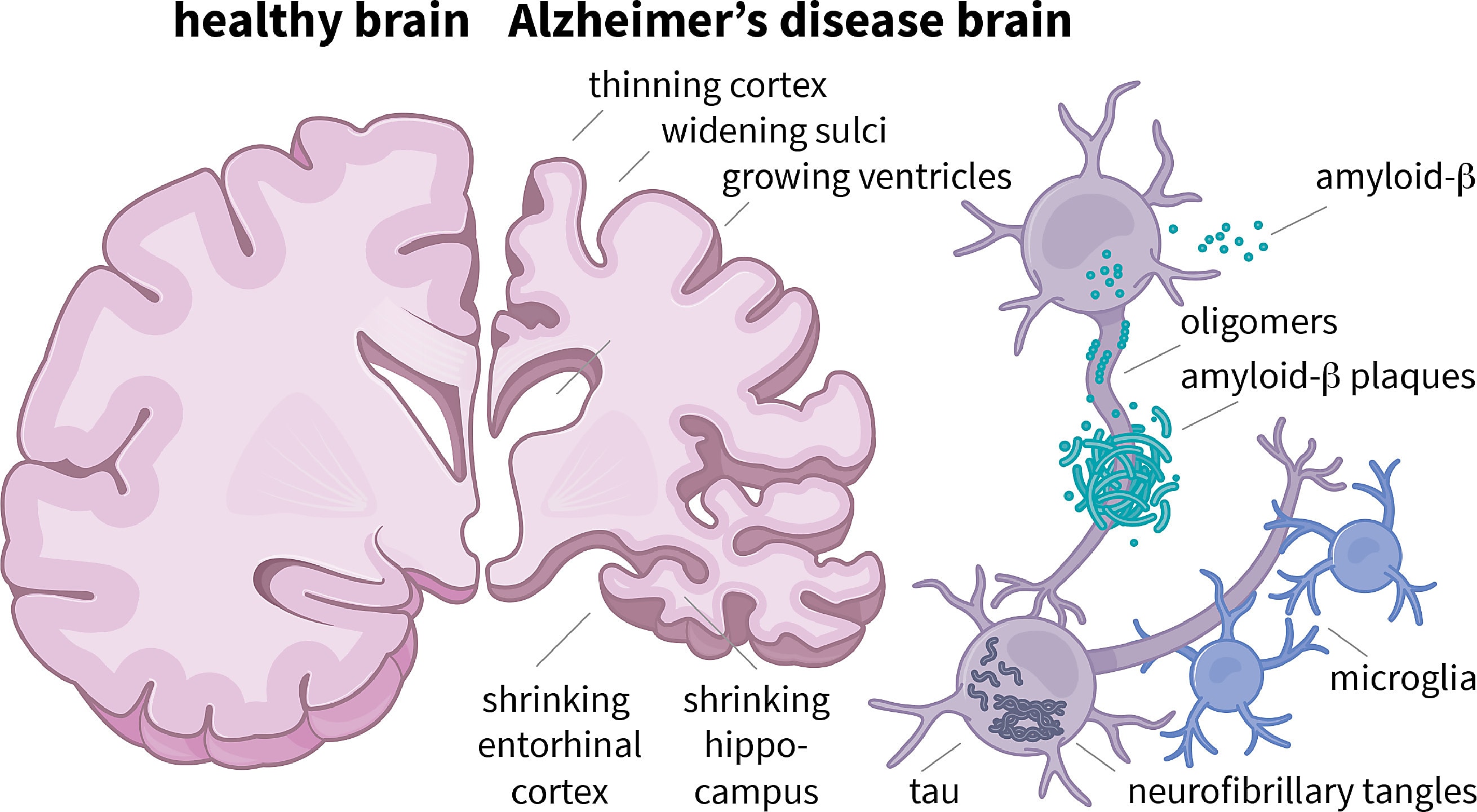 Figure 1. Alzheimer’s disease pathology. Amyloid-beta proteins are produced in neuronal membranes and oligomerize in the extracellular space, ultimately producing amyloid-beta plaques that interfere with neuronal function and trigger inflammation. Neurofibrillary tangles form from aggregates of hyperphosphorylated tau inside neurons, displacing organelles and disrupting vesicular transport required for synaptic transmission. The combined effect of these two events is implicated in the neuronal death and brain atrophy that leads to progressive cognitive decline. Brain Multiphysics 2: 10039 (2021) (4), (CC BY 4.0)