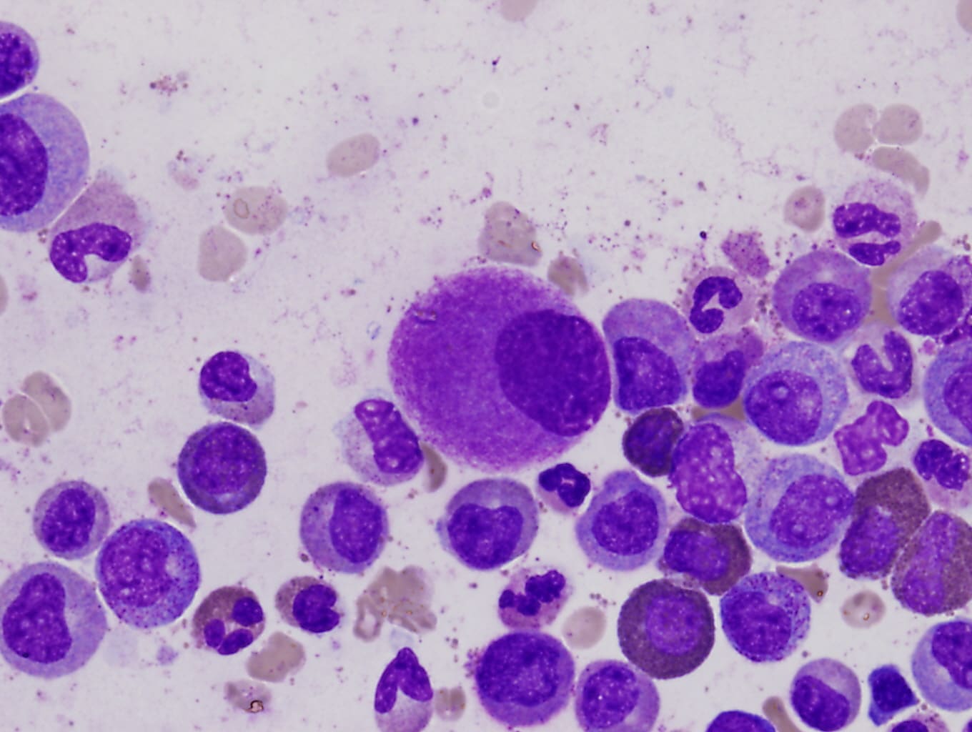 A small, hypolobated megakaryocyte (center of field) in a bone marrow aspirate, characteristic of chronic myeloid leukemia. CREDIT: Difu Wu, https://commons.wikimedia.org/wiki/File:Hypolobated_small_megakaryocyte.jpg