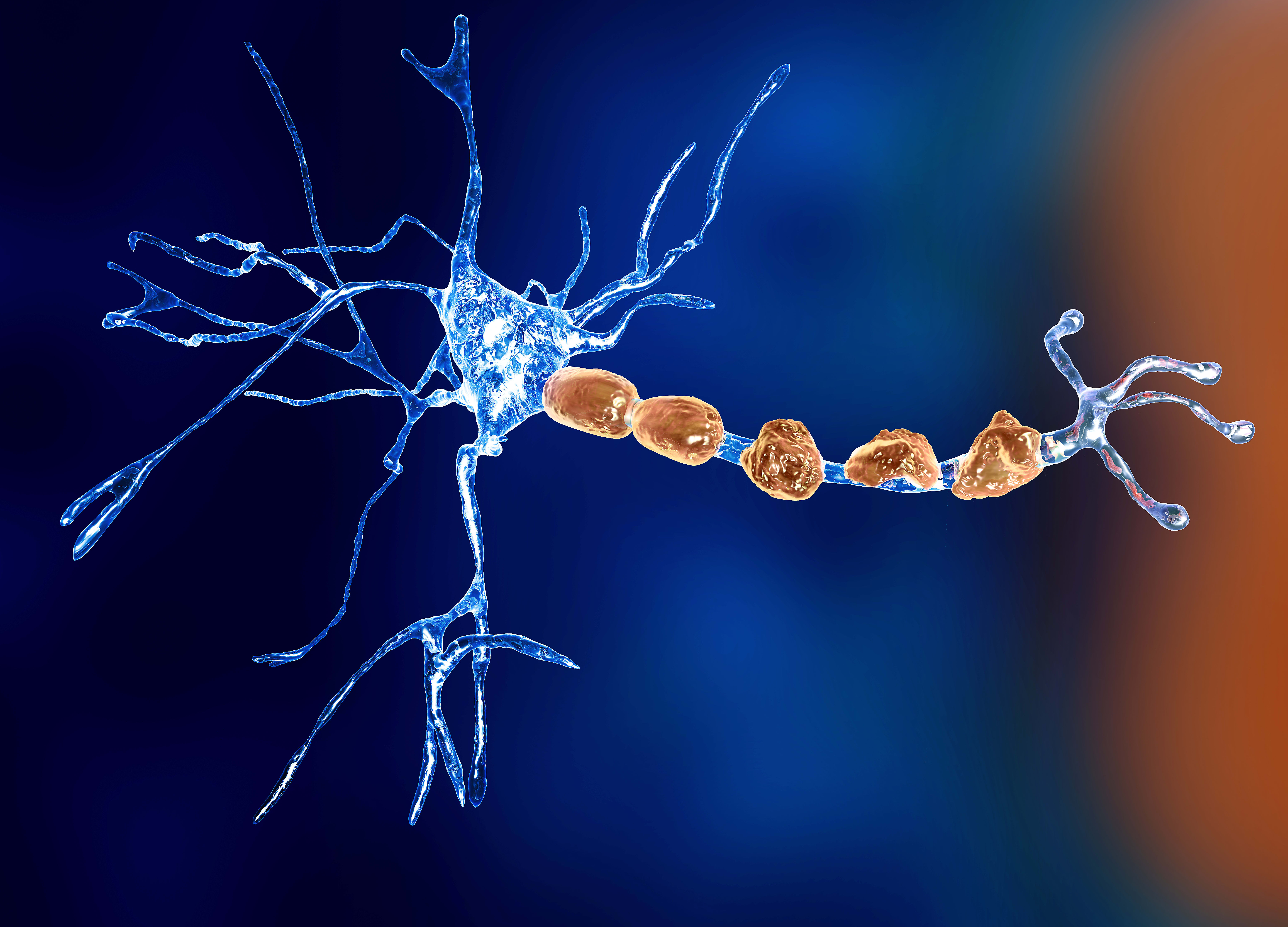 Figure 1. A neuron (blue) sheathed in myelin (orange) that is demonstrating demyelination from MS.