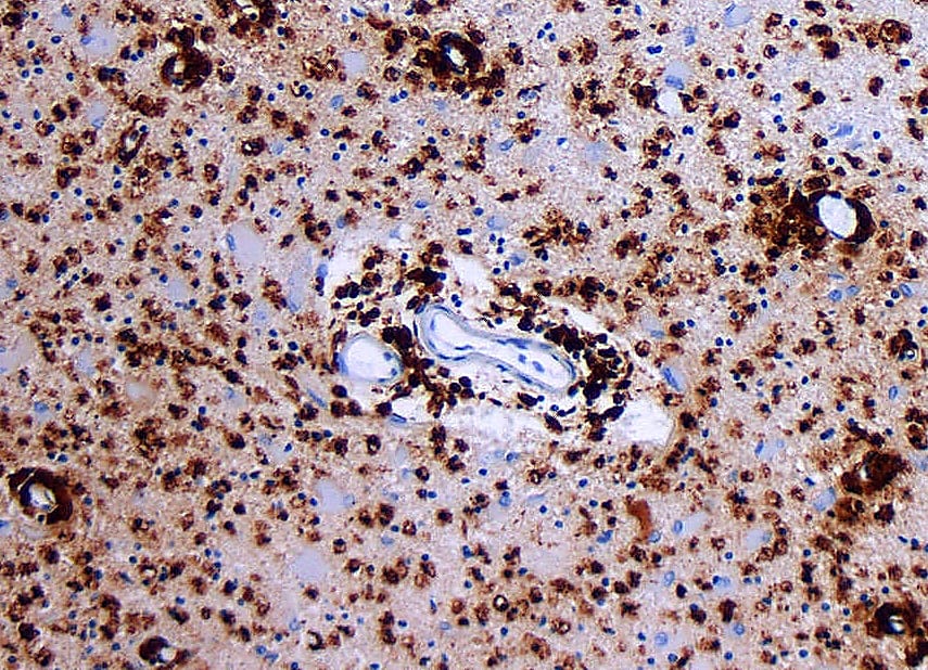 Figure 2. Demyelinating lesion surrounded by CD68-positive macrophages (stained via immunohistochemistry, in brown). Derived from an image provided by Marvin 101, used under a CC-BY-SA-3.0 license.