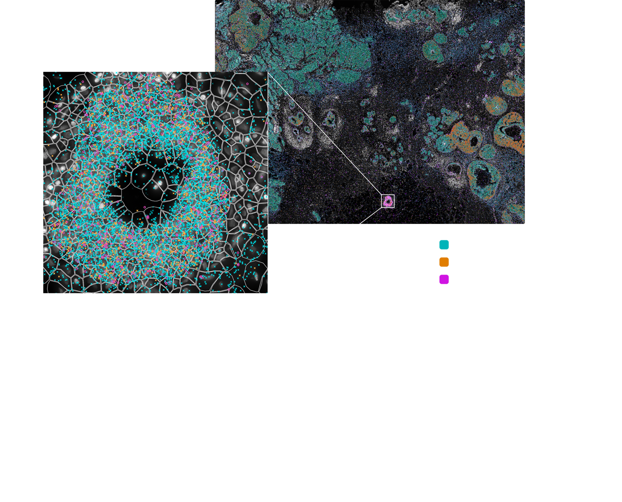 Xenium breast cancer sample data