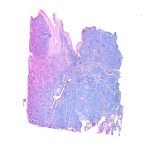 Lung Squamous Cell Carcinoma stained