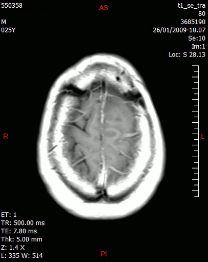 Transverse timelapse sectioning through an MRI of glioblastoma. CREDIT: Llorenzi - Own work. https://it.wikipedia.org/wiki/Glioblastoma
