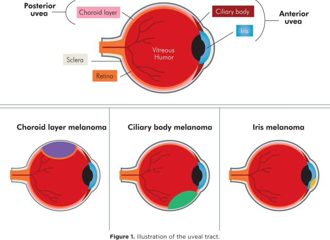 Illustration of the uveal tract. CREDIT: Chattopadhyay et al./Cancer 2016. Open access at https://acsjournals.onlinelibrary.wiley.com/doi/pdfdirect/10.1002/cncr.29727.