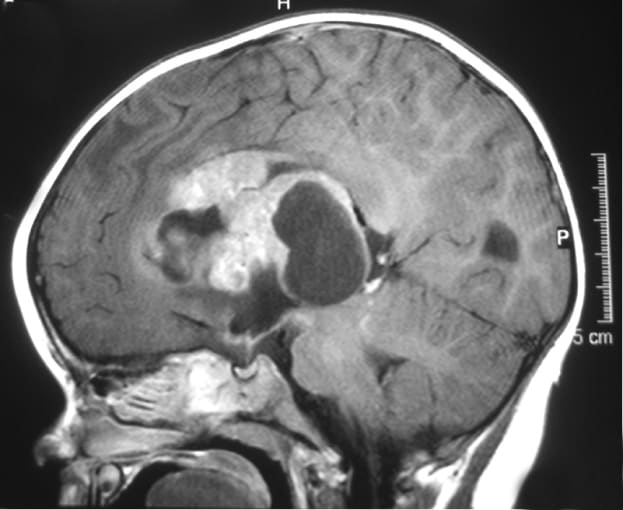 MRI of a supratentorial atypical teratoid/rhabdoid tumor (ATRT) in a young child. CREDIT: Marvin 101 - Own work. https://en.wikipedia.org/wiki/Atypical_teratoid_rhabdoid_tumor
