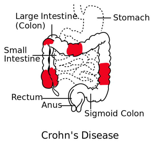 Diagram of Crohn’s disease, showing the distribution of inflammation in the gastrointestinal tract. Inflammation is often patchy, and interspersed with regions of non-inflamed tissue. CREDIT: Modified from File:Patterns of Crohn's Disease.svg by Samir, vectorized by Fvasconcellos (CC BY-SA 3.0)