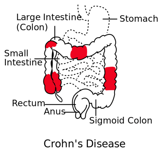 Single-cell analysis of Crohn's disease reveals a detailed picture