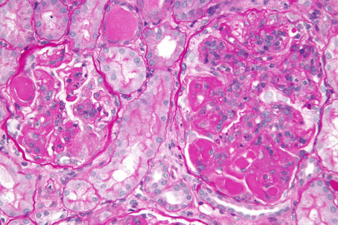 High magnification micrograph of diffuse proliferative lupus nephritis, class IV. CREDIT: Nephron - Own work (CC BY-SA 3.0)