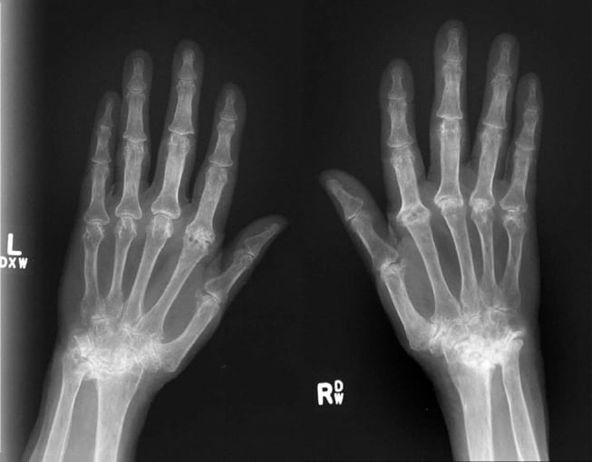 This image shows severe, rapidly progressive RA with severe damage to finger joints eight years after initial diagnosis. CREDIT: University College Dublin