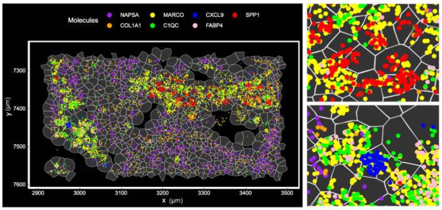 Figure 5. High-resolution visualization of cell subtypes in lung cancer using Xenium. A. Subsection of the same lung cancer sample from Figure 2, showing spatial distribution and colocalization of various lung macrophage and immune markers. B. Subsection of tissue from Figure 2B, showing differential expression of various immune markers in lung macrophages (MARCO+ cells). Image adapted from Figure 6J of Haga et al. 2023. (CC BY 4.0).