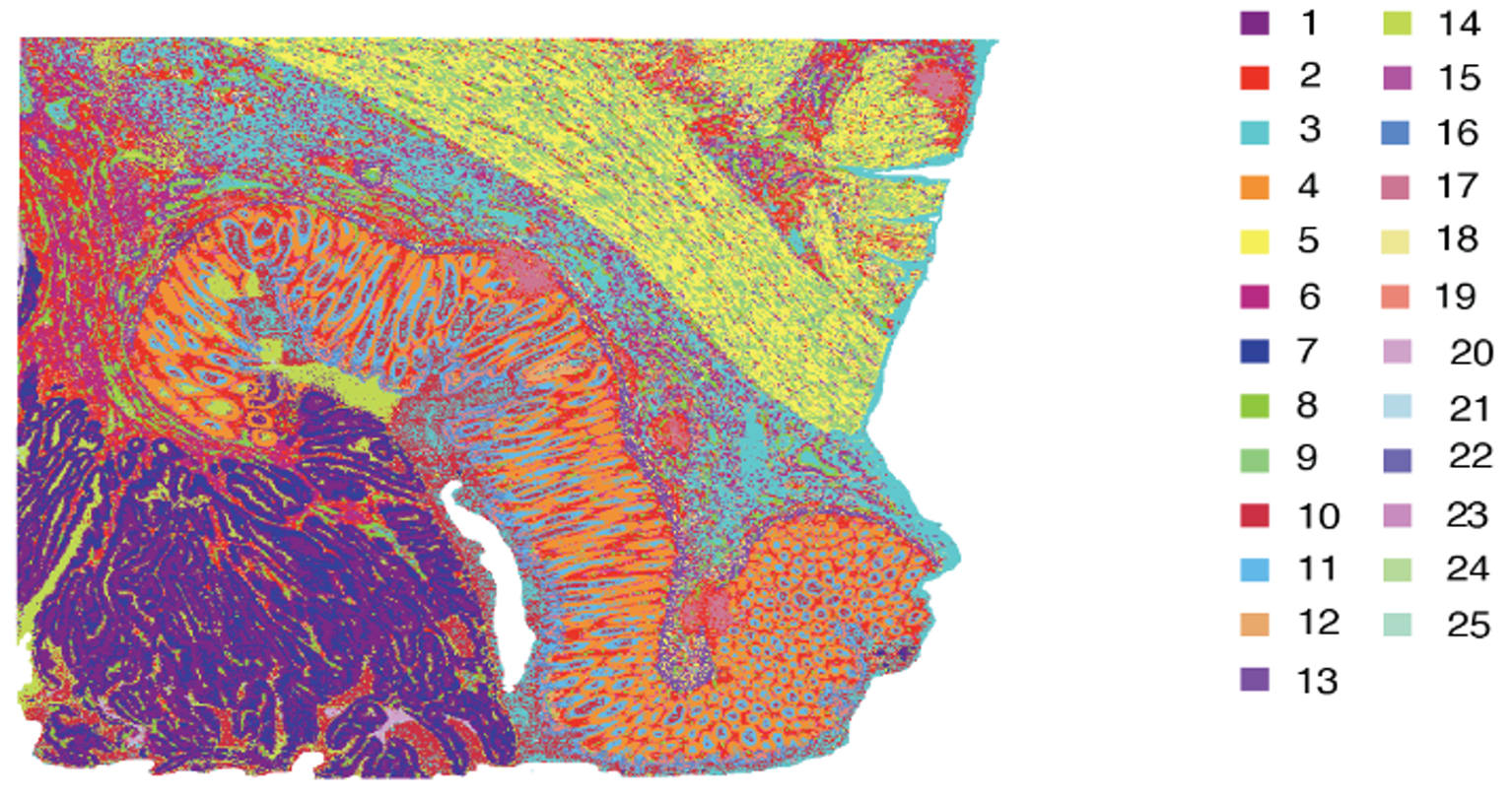Figure 1. FFPE human colorectal cancer analyzed using Visium HD Spatial Gene Expression. Each color represents areas with similar gene expression profiles. Image adapted from Figure 3 of Oliveira et al. 2024 (1) (CC BY 4.0).