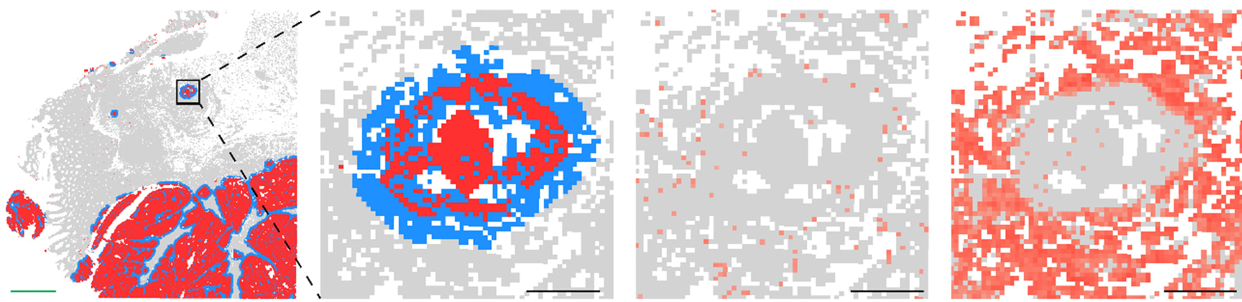 Figure 9. Composition and localization of peripheral and tumor cells in human FFPE colorectal cancer using the Visium HD assay. Image adapted from Figure 4 of Oliveira et al. 2024 (1) (CC BY 4.0).