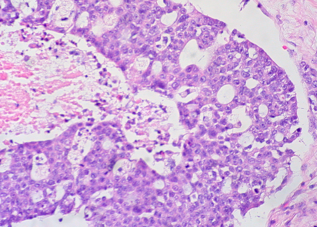 Serous carcinoma of ovary. Left ovary, medium power pathological and histological images. Credit: Ed Uthman, Houston, TX, USA (CC BY 2.0).